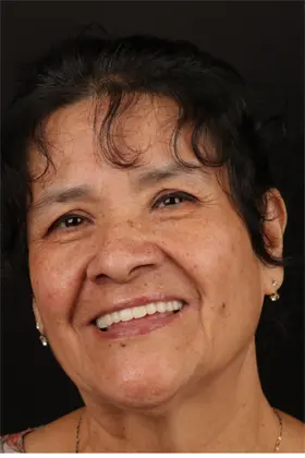 Patient showcasing a radiant smile after complete smile reconstruction with veneers and crowns.